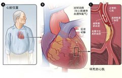 冠心病的起因是什么?